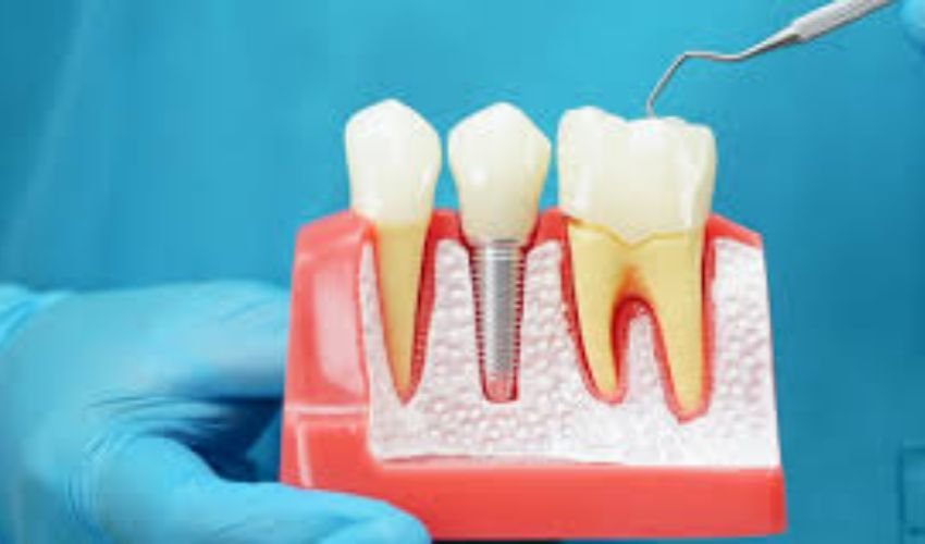 Implantes Dentales